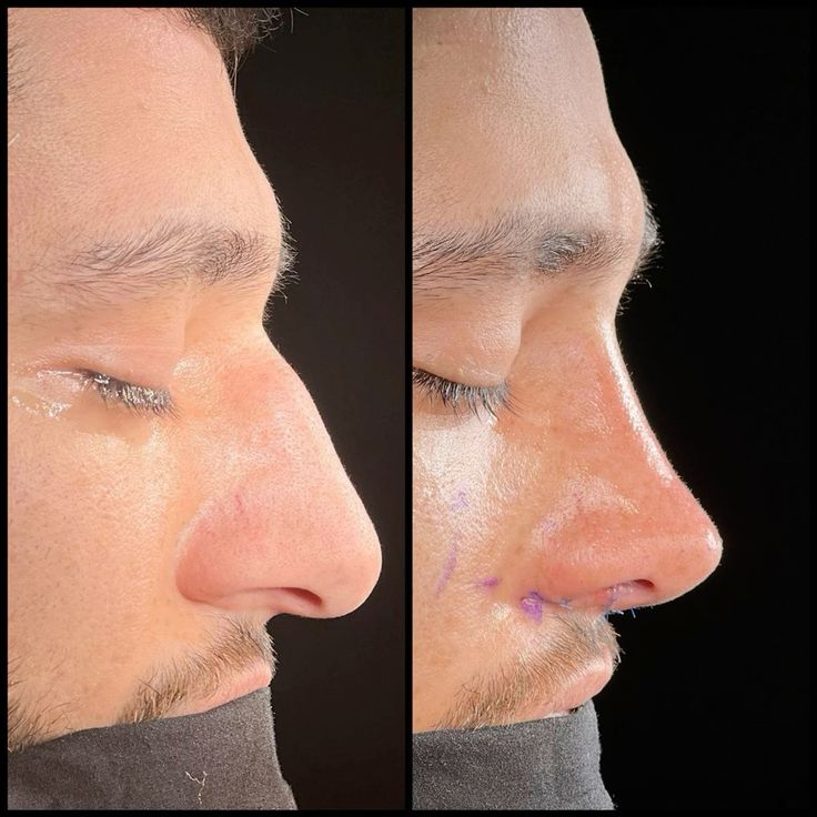 Rhinoplasty before and after result 1